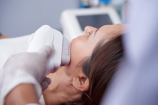 Side burns laser removal